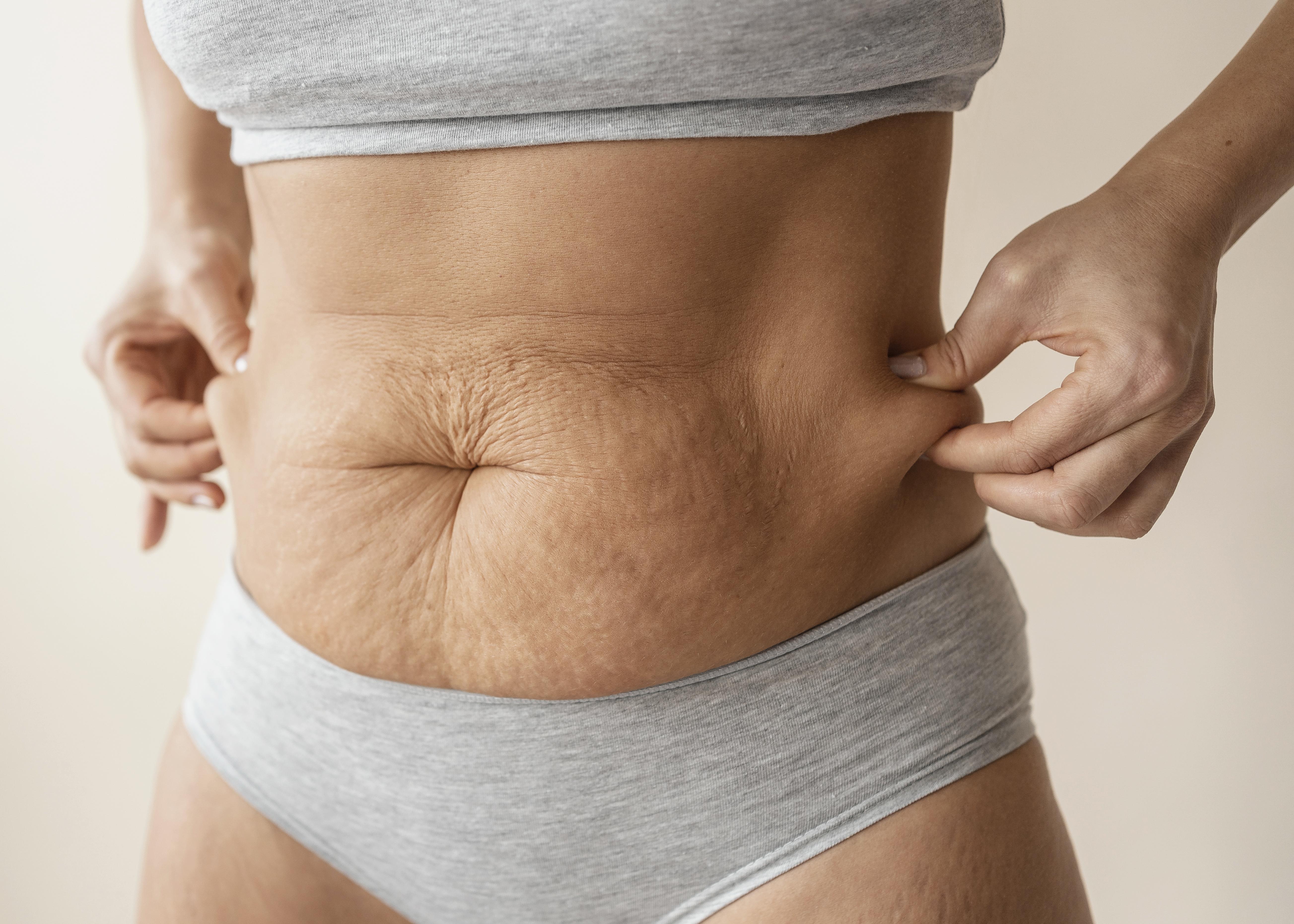 Cellulit wodny – czym jest i jak wygląda?